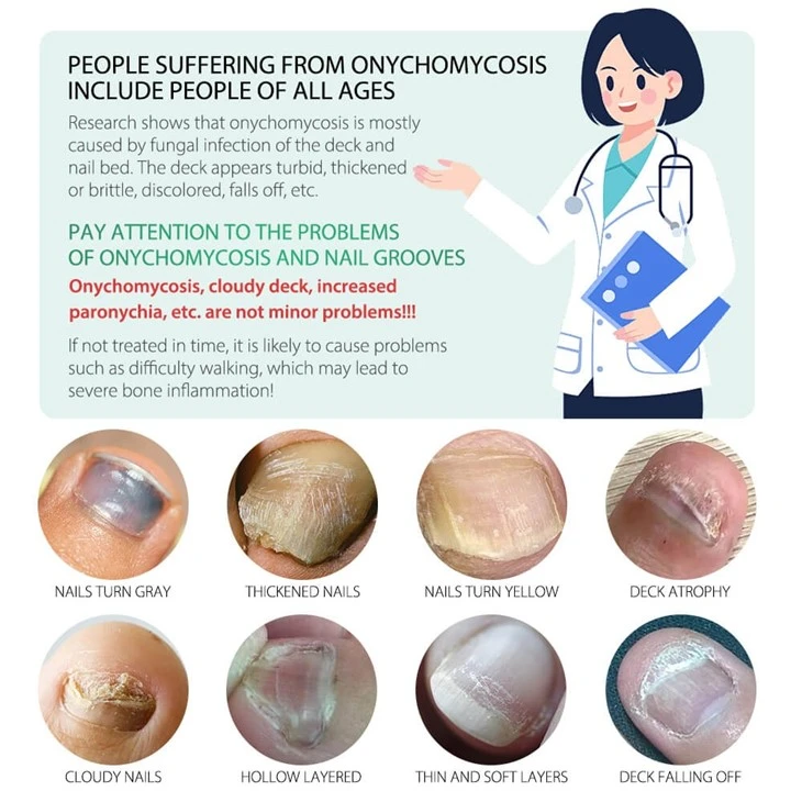 7 Days Nail Fungus Treatment Serum factory